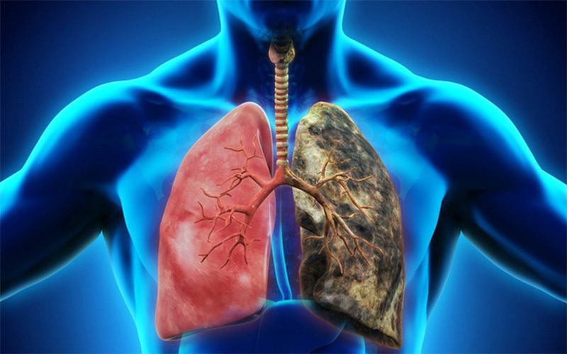 Ung thư phổi chủ yếu đến từ khói thuốc
