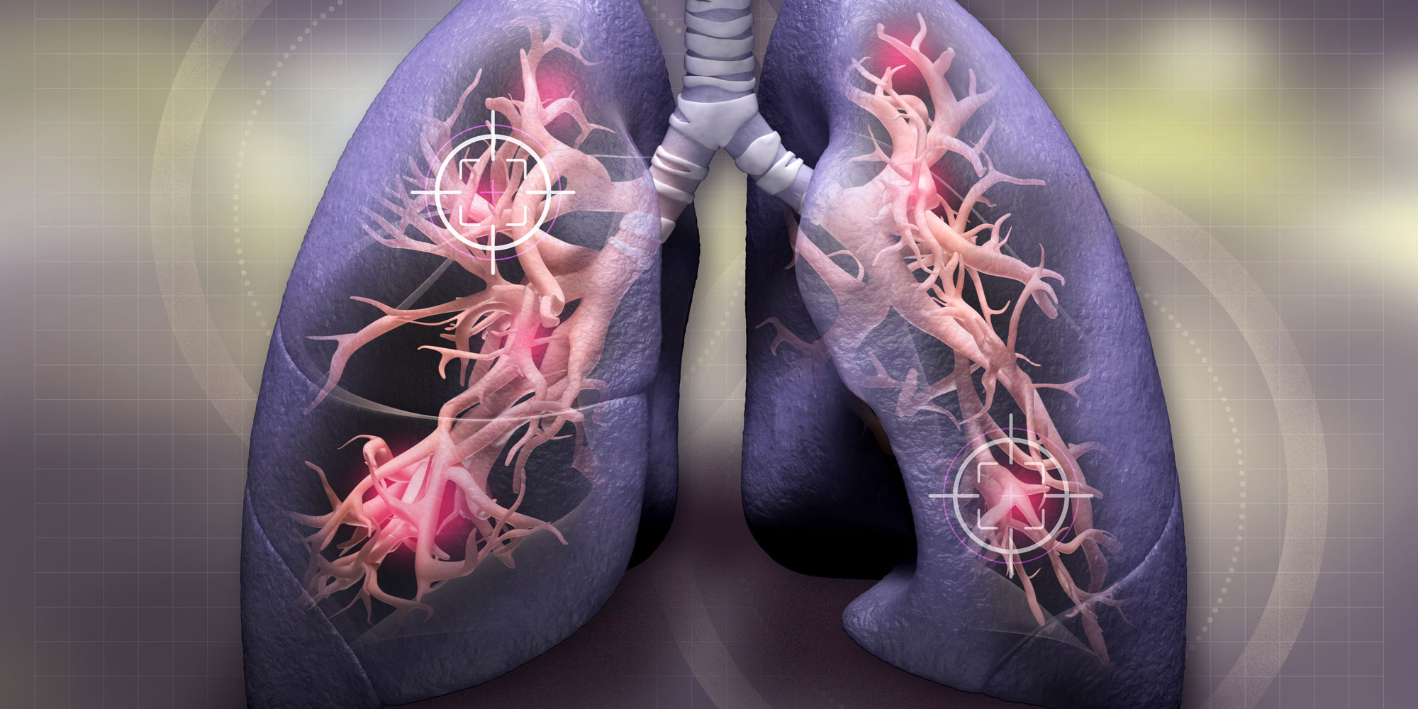 Các biện pháp phòng ngừa, chuẩn đoán và điều trị ung thư phổi hiện nay